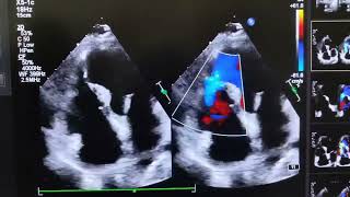 VENTRICULAR SEPTAL REPTUREVSR [upl. by Eliseo]