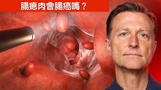 大腸瘜肉是癌症嗎自然療法柏格醫生 Dr Berg [upl. by Pat]