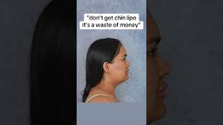 INSANE chin lipo results 😱🔥 chinlipo chinliposuction plasticsurgery glowup jawline snatched [upl. by Nette]