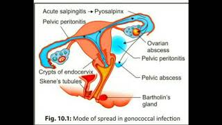 Pelvic inflammatory diseasePid management [upl. by Joed]