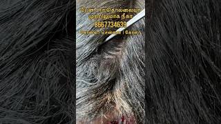 Lice removal  lice  how to remove lice from hair  how to  💯 results in single within 2hrs [upl. by Placida]