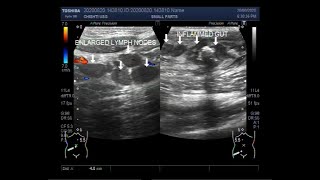 Ultrasound Video showing Increased gut wall thickness narrowed lumen amp Mesenteric Lymphadenopathy [upl. by Nylrahc]