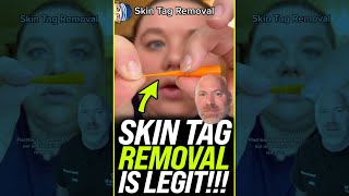 Skin Tag Removal is LEGIT 😱 shorts [upl. by Diver]