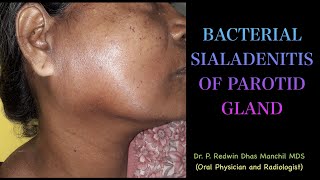 Bacterial Sialadenitis of parotid gland  An interesting case report [upl. by Eicyak]