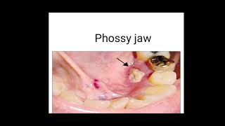 phossy jaw fmttoxicology [upl. by Louanne]