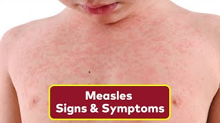 The 3 Warning Signs of Measles To Look Out For  How To Spot Measles Rash [upl. by Novrej268]