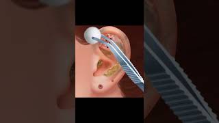 ASMR Ear Treatment Animation  Relaxing Ear Cleaning and Massage Sounds asmr tretment [upl. by Rojas288]