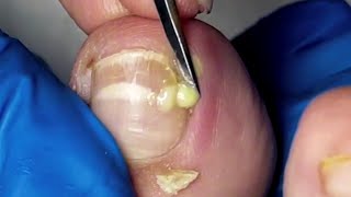 Pus Leaks Out From Infected Ingrown Toenails 【Yinuo Pedicure】 [upl. by Vinita]