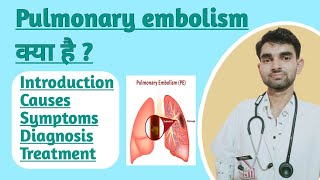 Pulmonary embolism in Hindi  Causes  Sign and Symptoms  Treatment of Pulmonary Embolism [upl. by Sirovart487]