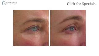 Ultherapy Before amp After Photos Princeton NJ  Non Surgical Skin Lift [upl. by Birch]