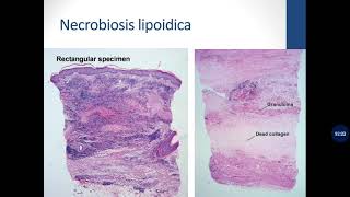 Basic Dermatopathology 11 Granulomatous [upl. by Drooff]