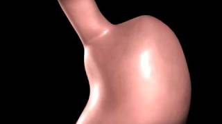 Gastric Bypass animation [upl. by Yenttirb]