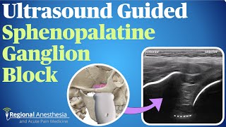 Ultrasound Guided Sphenopalatine Ganglion Block [upl. by Naynek]