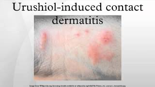 Urushiolinduced contact dermatitis [upl. by Ad]