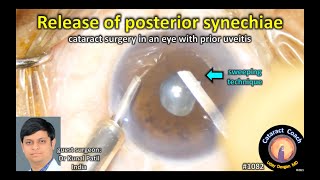 CataractCoach 1082 fixing posterior synechiae during cataract surgery [upl. by Booze435]