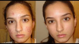 A true miracle How I got rid of my acne Daily skincare routine [upl. by Eelydnarb]