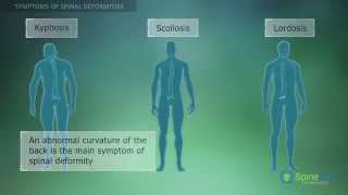 Spinal Deformities Symptoms [upl. by Aurelia]