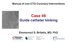 Case 49 PCI Manual  Guide catheter kinking [upl. by Atik]