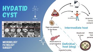 Hydatid cyst [upl. by Ramyaj253]