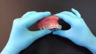 How to use orthodontic wax [upl. by Epilef]