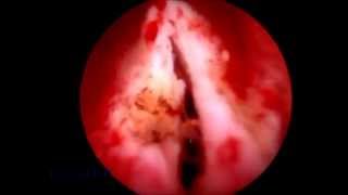 Utricular cyst deroofing [upl. by Pliske]