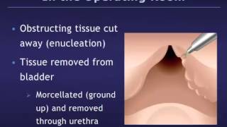 Holmium Laser Enucleation of the Prostate HoLEP for Benign Prostatic Hyperplasia BPH [upl. by Amble941]