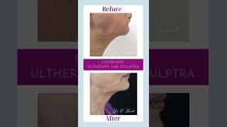 Combining Ultherapy and Sculptra [upl. by Herold912]