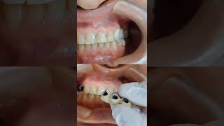 ✨Coronas de porcelana sobre implantes implantesdentales molar cute saludbucal [upl. by Cheung]