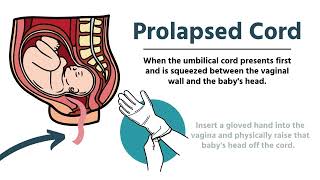 Pregnancy amp Delivery Emergencies in EMS [upl. by Cordle]