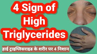 Sign of high triglycerides on body l हाई ट्राइग्लिसराइड के लक्षण l Hindi [upl. by Knobloch]