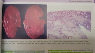 Chronic Pyelonephritis  SPECIAL PATHOLOGY [upl. by Lered]