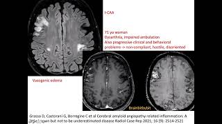 69 ICAA and ABRA CAA related inflammation amyloid beta related angiitis encephalopathy elderly [upl. by Amadus917]