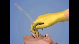 Laryngeal Mask Airway Insertion [upl. by Yelak910]