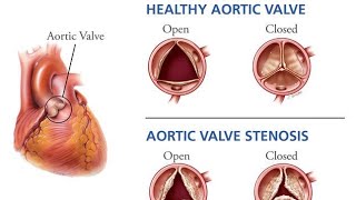 Aortic Stenosis [upl. by Wendall300]