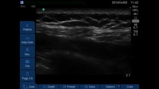 Serratus Plane Block [upl. by Fachan]