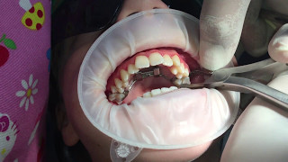 Removal of Rapid Palatal Expansion Appliance [upl. by Lonyer]