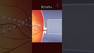 Nearsightedness  Myopia  and its treatment  medical video [upl. by Sullecram]