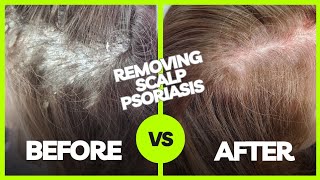 Removing Plaque Scalp Psoriasis  Using The AntiFungal Bundle myhappyscalpcom [upl. by Rebhun]