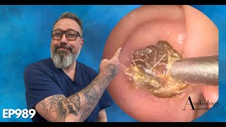 The MOST SATISFYING ring of dry ear wax removal EP989 [upl. by Kam]