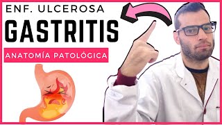 Anatomía Patológica  Enfermedad ulcerosa y gastritis [upl. by Attlee]