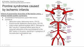 Pontine syndromes caused by ischemic infarcts [upl. by Terrene443]