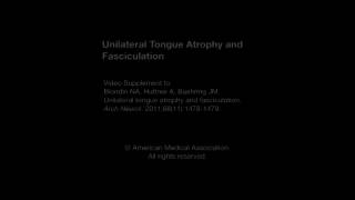 Unilateral Tongue Atrophy and Fasciculation [upl. by Thompson]