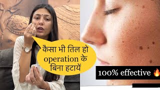 Chehre Ke Til Ka ilaj  Remove Moles Permanently Without Operation  Home Remedy  Dr Upasana Vohra [upl. by Sallad]