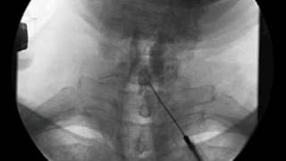 Cervical Interlaminar Epidural Steroid Injection  ThePainSourcecom [upl. by Eppilihp]