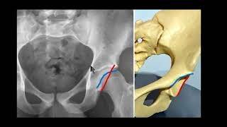 MRI Hip Made Easy [upl. by Lady]