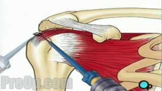 Rotator Cuff Repair Arthroscopic Surgery PreOp Patient Education [upl. by Aihpledalihp]