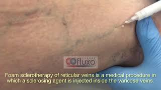 Foam sclerotherapy for treating spider veins and varicose veins [upl. by Eussoj]