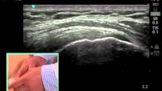 How To Ultrasound Guided Shoulder Injection Scanning Technique Video [upl. by Favin400]