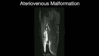 Arteriovenous Malformation [upl. by Alaik]