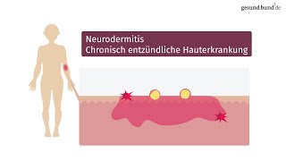 Was ist Neurodermitis und wie kann man sie behandeln [upl. by Dulcea396]